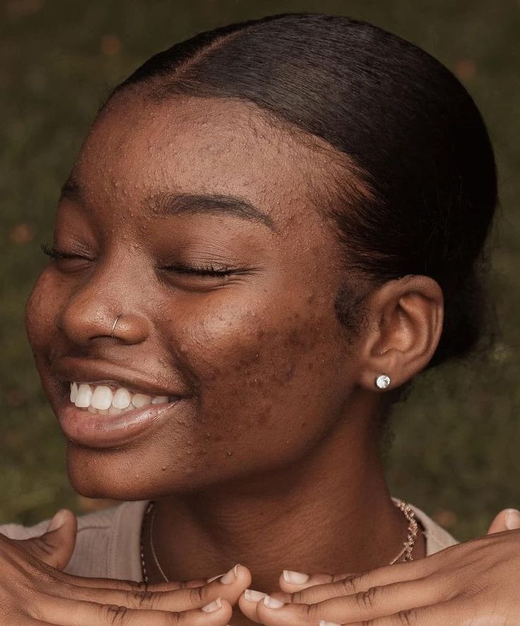 Dark spot and pigmentation